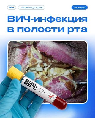ВИЧ-инфекция: стоматологические маркеры для ранней диагностики.